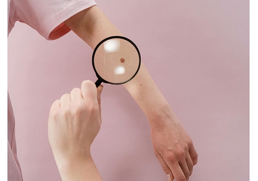Melanomas ārstēšanā vājie posmi – diagnostika un zāļu kompensācija 