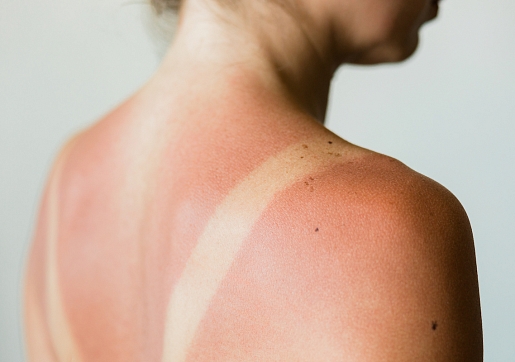 Ko darīt, ja āda ir apdegusi saulē? Skaidro farmaceite