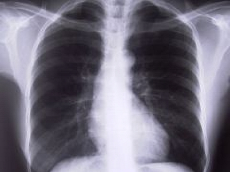 Gulbenē iedzīvotājus informēs par tuberkolozi