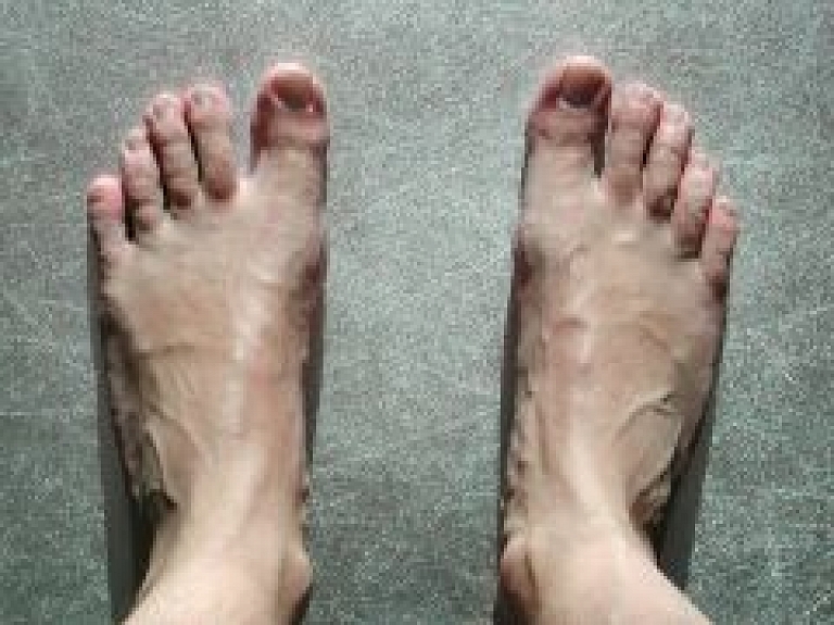 Latgalē vīrietis staigā slapjos apavos un gūst pēdu apsaldējumu