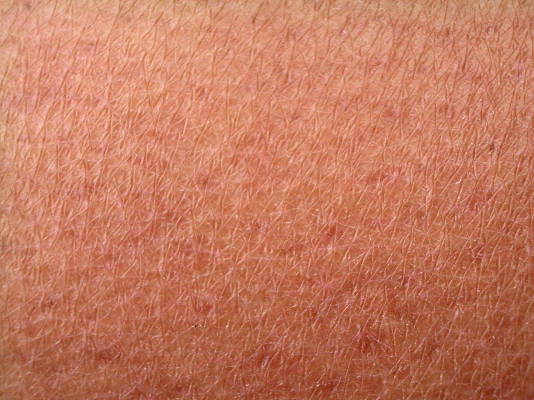 Eiromelanomas dienas ietvaros valmieriešus aicina pārbaudīt savu veselību

