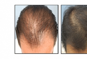 Galvas mezoterapija – visefektīvākais veids, kā saglabāt matu krāšņumu

