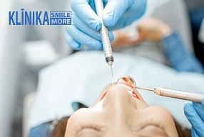 Zobu sakņu kanālu ārstēšana: kas par to ir jāzina?