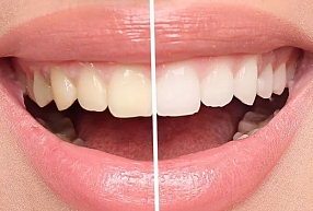 Zobu balināšana, terapija un mīti: kas patiesībā notiek ar tavu smaidu?