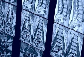 “Šausmīgie” magnētiskās rezonanses un datortomogrāfijas apraksti – vai tiešām jāuztraucas?