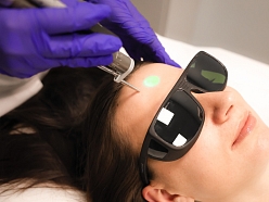 Lāzerepilācijas procedūra