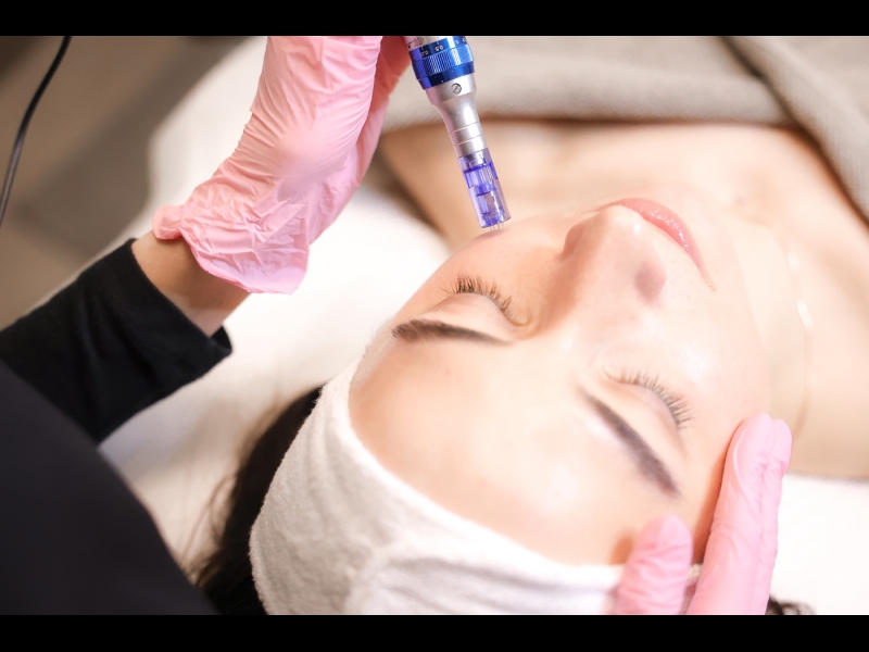 Aleksandrīta lāzerepilācija