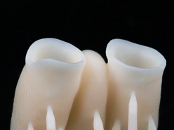 3D printēti pagaidu kroņi