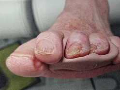 Individuālo ortožu izgatavošana