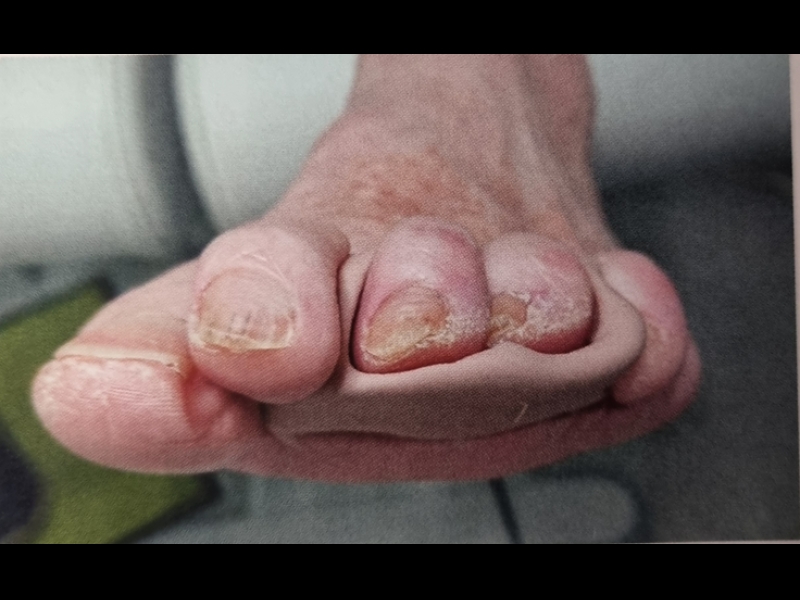 Individuālo ortožu izgatavošana