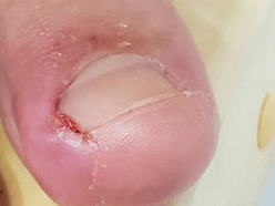 ieaugušu nagu aprūpe