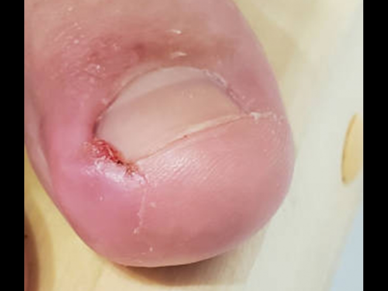 ieaugušu nagu aprūpe