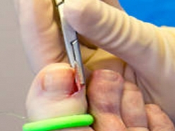 ieaugušu nagu aprūpe