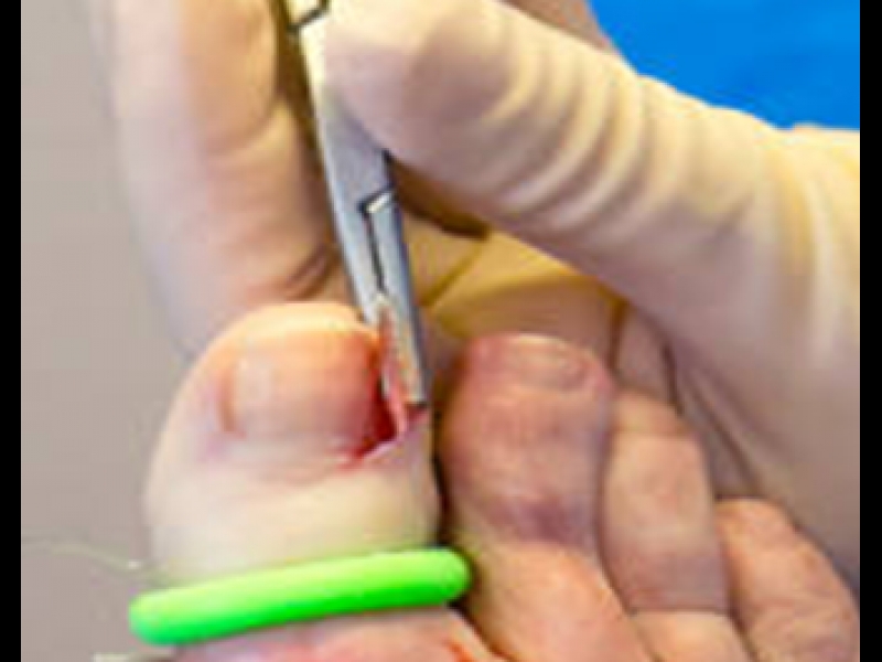 ieaugušu nagu aprūpe