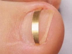 Ieauguša naga korekcija