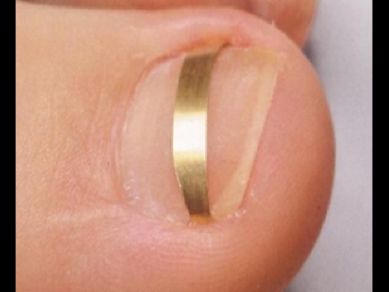 Ieauguša naga korekcija