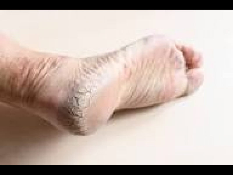 Pēdu ādas apstrāde