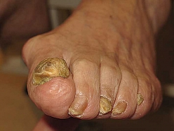 traumētu vai bojātu nagu apstrāde