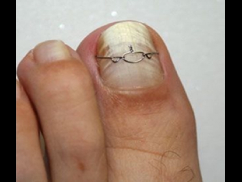 ieaugušu nagu korekcija