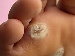 Kārpas vai varžacs apstrāde