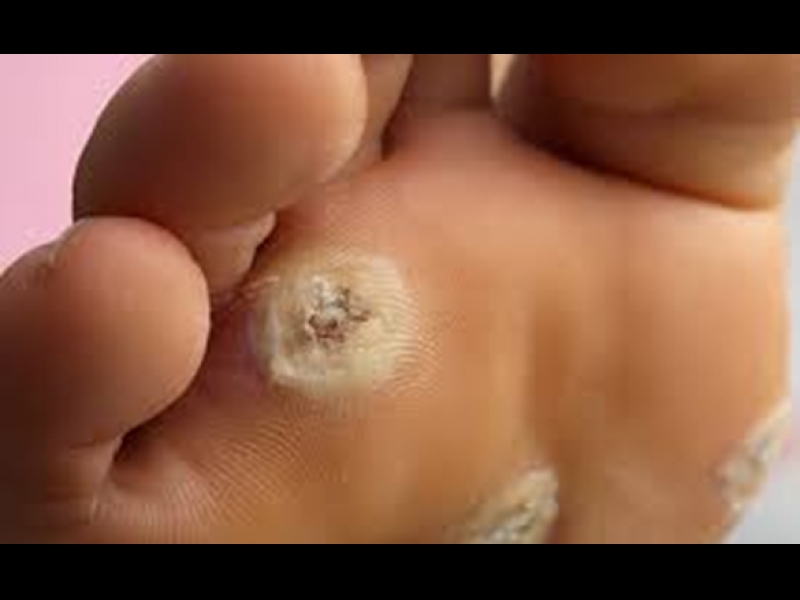 Kārpas vai varžacs apstrāde