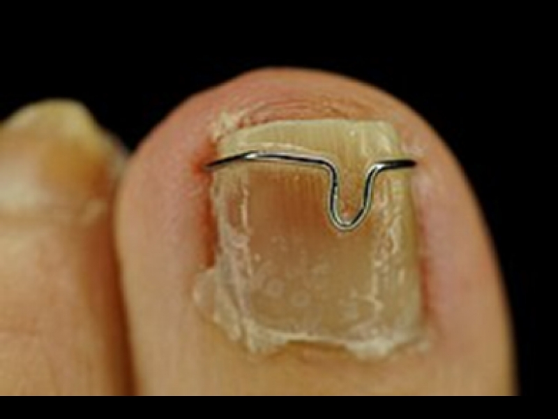 ieaugušu nagu korekcija