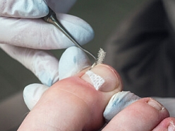 Tamponāde vai korekcija ar stangām