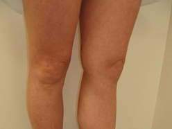 Vēnu pārbaude diagnostika Rīgā Cēsīs Valmiera