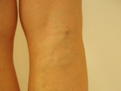 Vēnu centrs klīnika Rīgā Cēsīs Valmierā