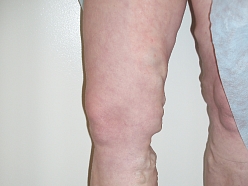 Vēnu centrs klīnika Alūksnē Limbažos Madonā