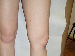 Vēnu diagnostika ārstēšana operācijas Rīgā Vidzemē