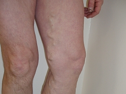 Vēnu ārstēšana operācijas Alūksnē Limbažos Madonā