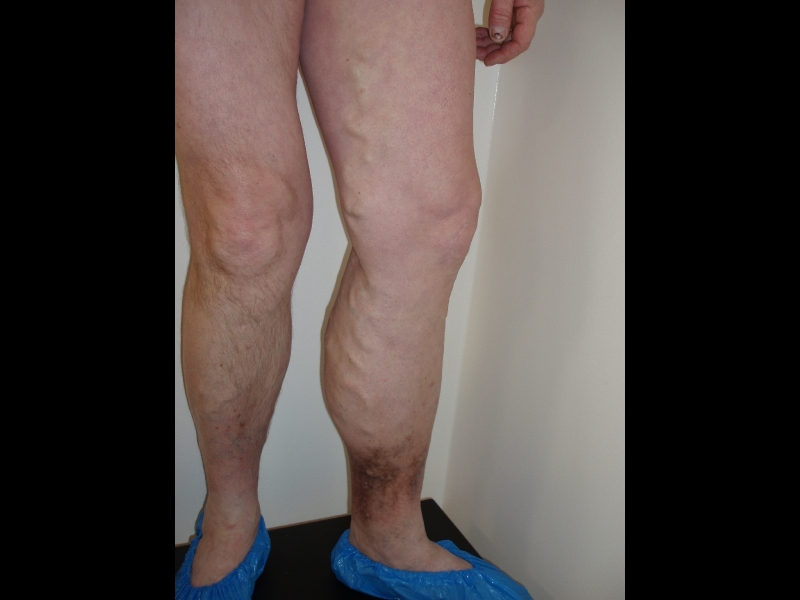 Vēnu ārstēšana operācijas Alūksnē Limbažos Madonā