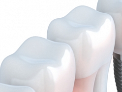 zobu implantācija