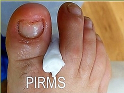 Bojāta naga restaurācija