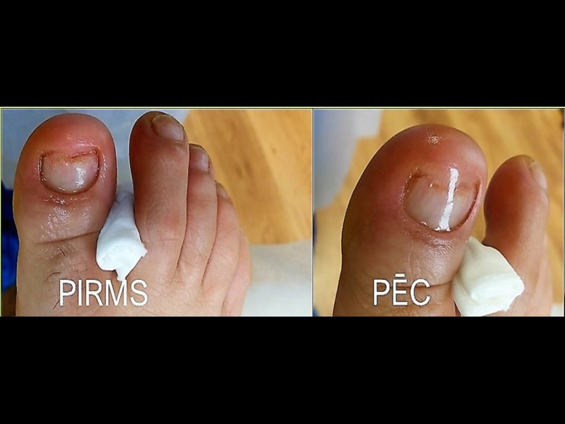 Bojāta naga restaurācija