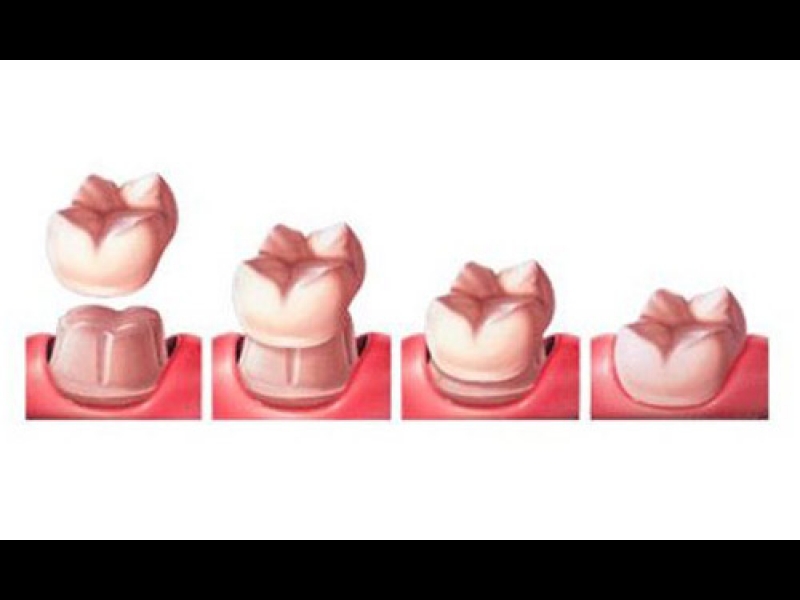 Zobu implanti