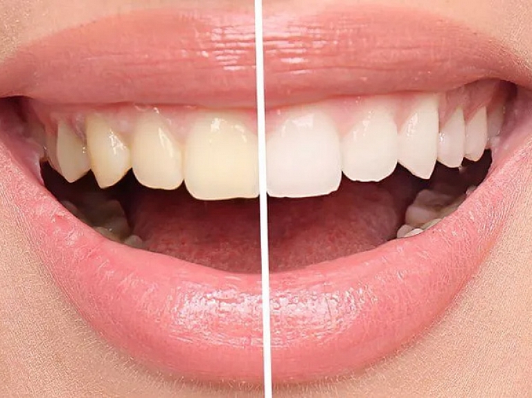 Zobu balināšana, terapija un mīti: kas patiesībā notiek ar tavu smaidu?