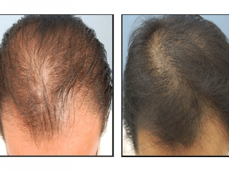 Galvas mezoterapija – visefektīvākais veids, kā saglabāt matu krāšņumu

